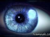 میخ در چشم