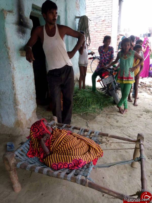 بیماری عجیب زن هندی بعد از تولد فرزندش + تصاویر بیماری عجیب زن هندی