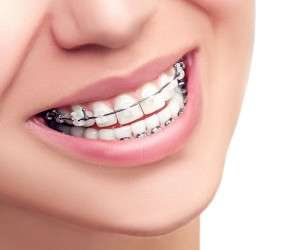 انواع مختلف ارتودنسی