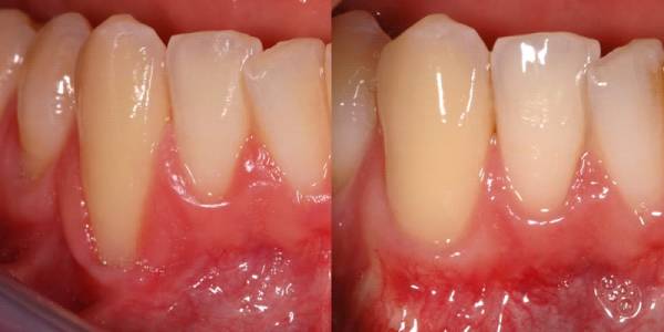 سرطان دهان دندانپزشک