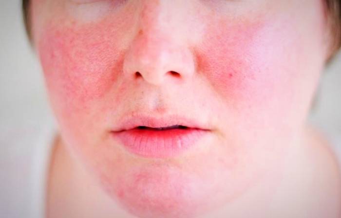 علائم کووید 19