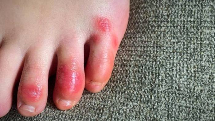 نشانه های انگشت کوویدی مشکلات پوستی کرونا