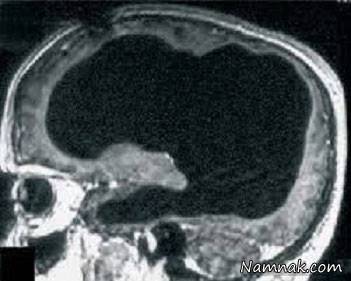 زندگی عادی با 10 درصد مغز مغز