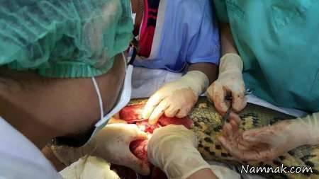 برداشت تومو از قلب مار تومور قلبی