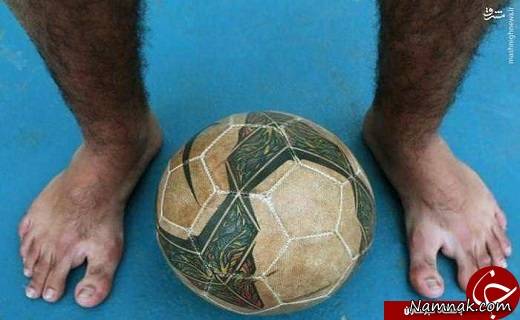 علت شش انگشتی شدن جنین