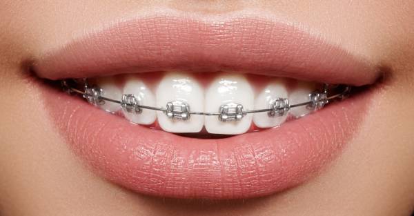 ارتودنسی نامرئی ارتودنسی