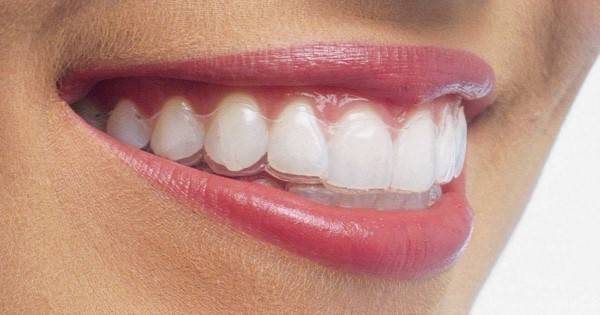 ارتودنسی ارتودنسی نامرئی