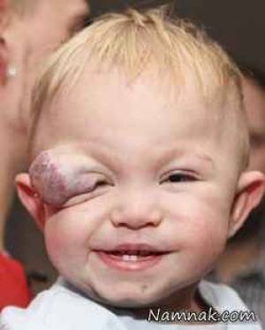 خال مادرزادی کودک