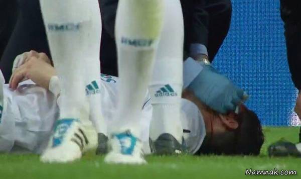 مصدومیت خونین کریستیانو رونالدو مقابل دپورتیوو مصدومیت کریستیانو رونالدو