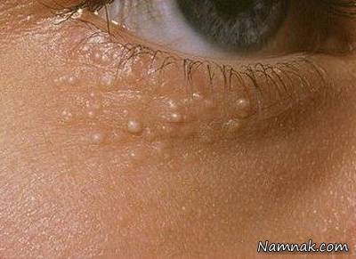 علت بروز دانه های سفید زیر چشم دلیل ظاهر شدن دانه های سفید زیر چشم چیست؟
