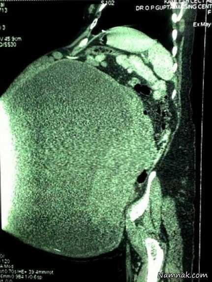 جراحی تومور