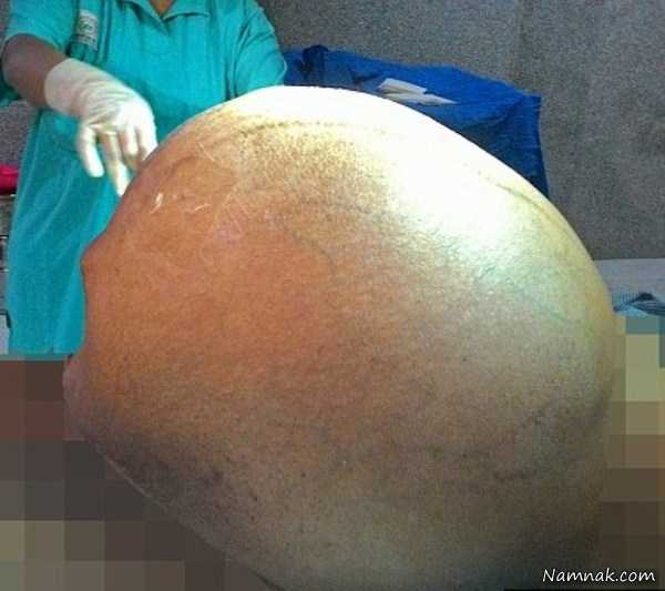 جراحی تومور