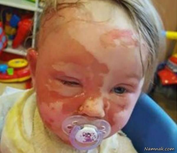 سوختگی شدید صورت کودک صورت کودک