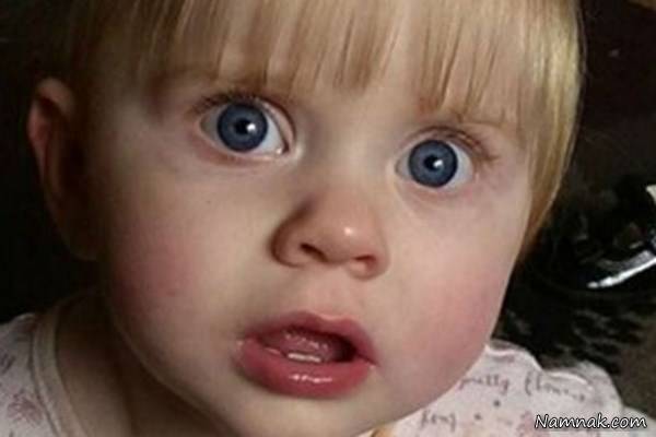 حادثه تلخ روی صورت کودک صورت کودک