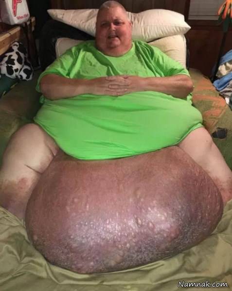 بزرگترین تورمور شکمی دنیا تورمور شکمی