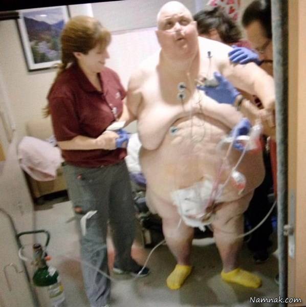 بعد از جراحی تورمور شکمی تورمور شکمی