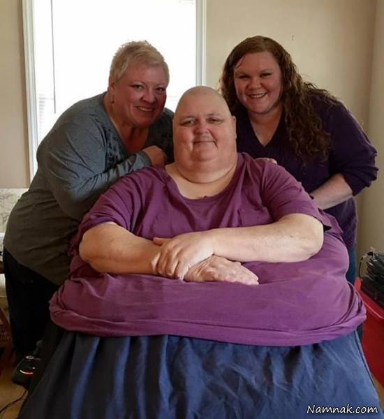 تورمور شکمی بزرگ و غول پیکر تورمور شکمی