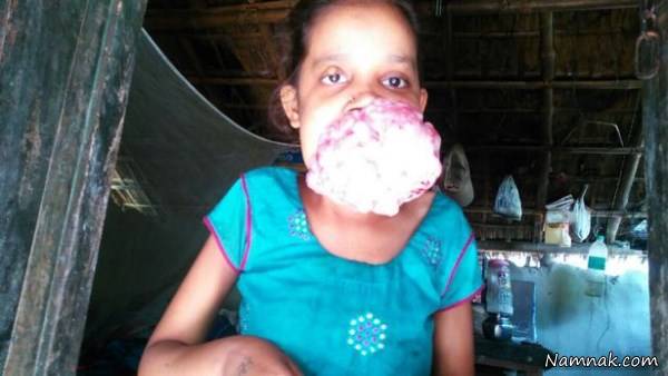  تومور دهان وحشتناک