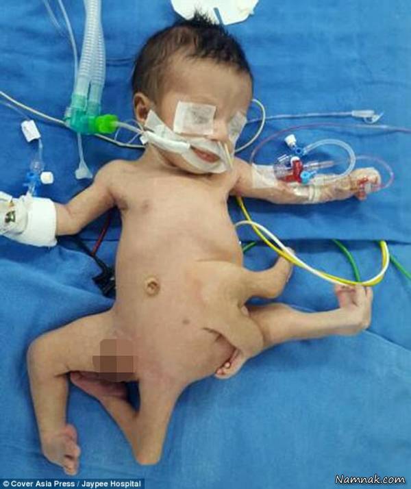 نوزاد 8 دست و پا