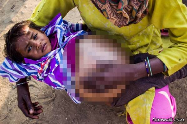 تومور کودک هندی تومور کودک