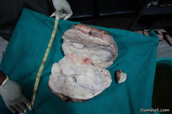 عکس تومور کودک تومور کودک