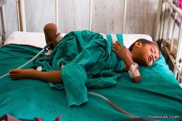 جراحی تومور کودک تومور کودک