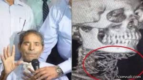 سوزن بدن 