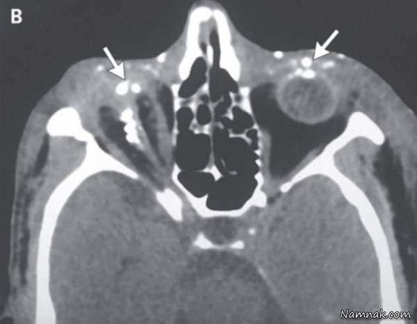 چشم کور شده چشم کور